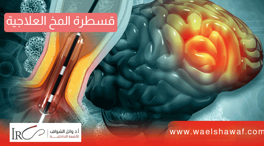 قسطرة المخ في مصر: التكلفة|دواعي عمل قسطره المخ| المضاعافات