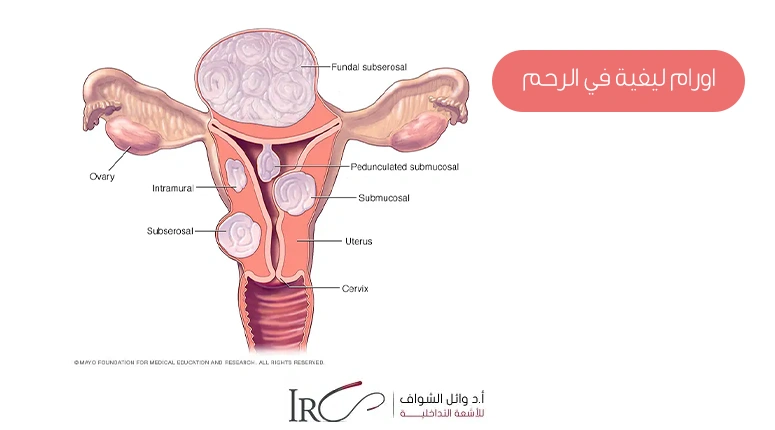 اورام ليفية في الرحم