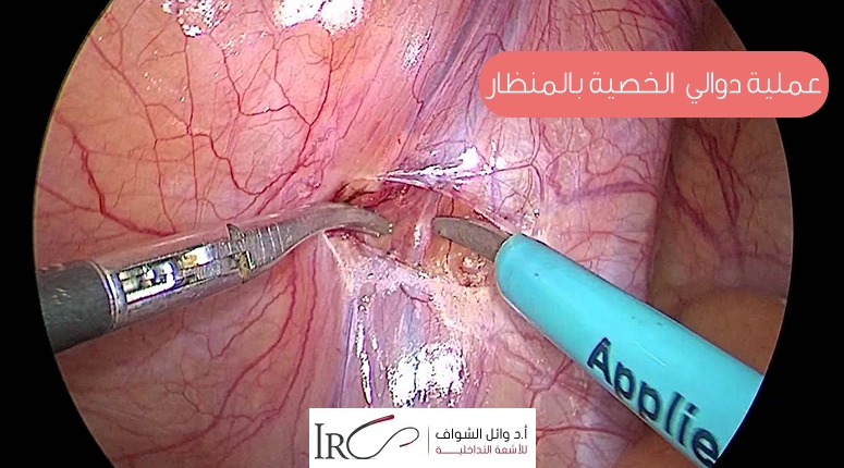 عملية دوالي الخصية بالمنظار