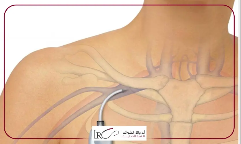 تركيب قساطر الحقن الكيماوي
