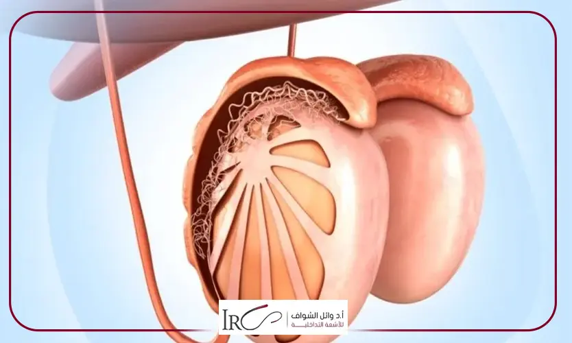 دوالي الخصية