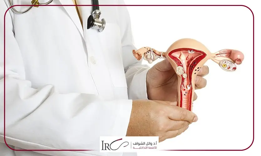 اعراض الورم الليفي في الرحم