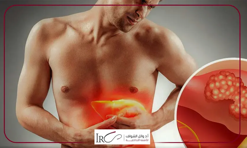 أعراض سرطان الكبد المتأخرة