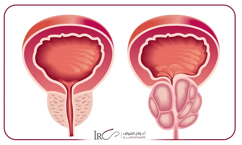 علاج تضخم البروستاتا